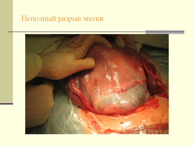 Неполный разрыв матки